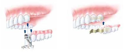 Modellgussprothese mit Gaumenabdeckung (links) sowie Geschiebeprothese befestigt
an zwei dafür beschliffenen und überkronten Zähnen (rechts).