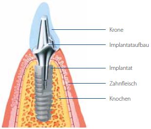 Zahnimplantat