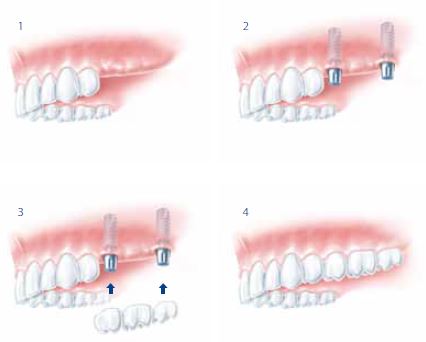 Brücke auf zwei Implantaten im Seitenzahnbereich