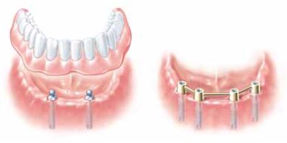 55-Herausnehmbare Versorgung auf Kugelkopf Implantataufbauten